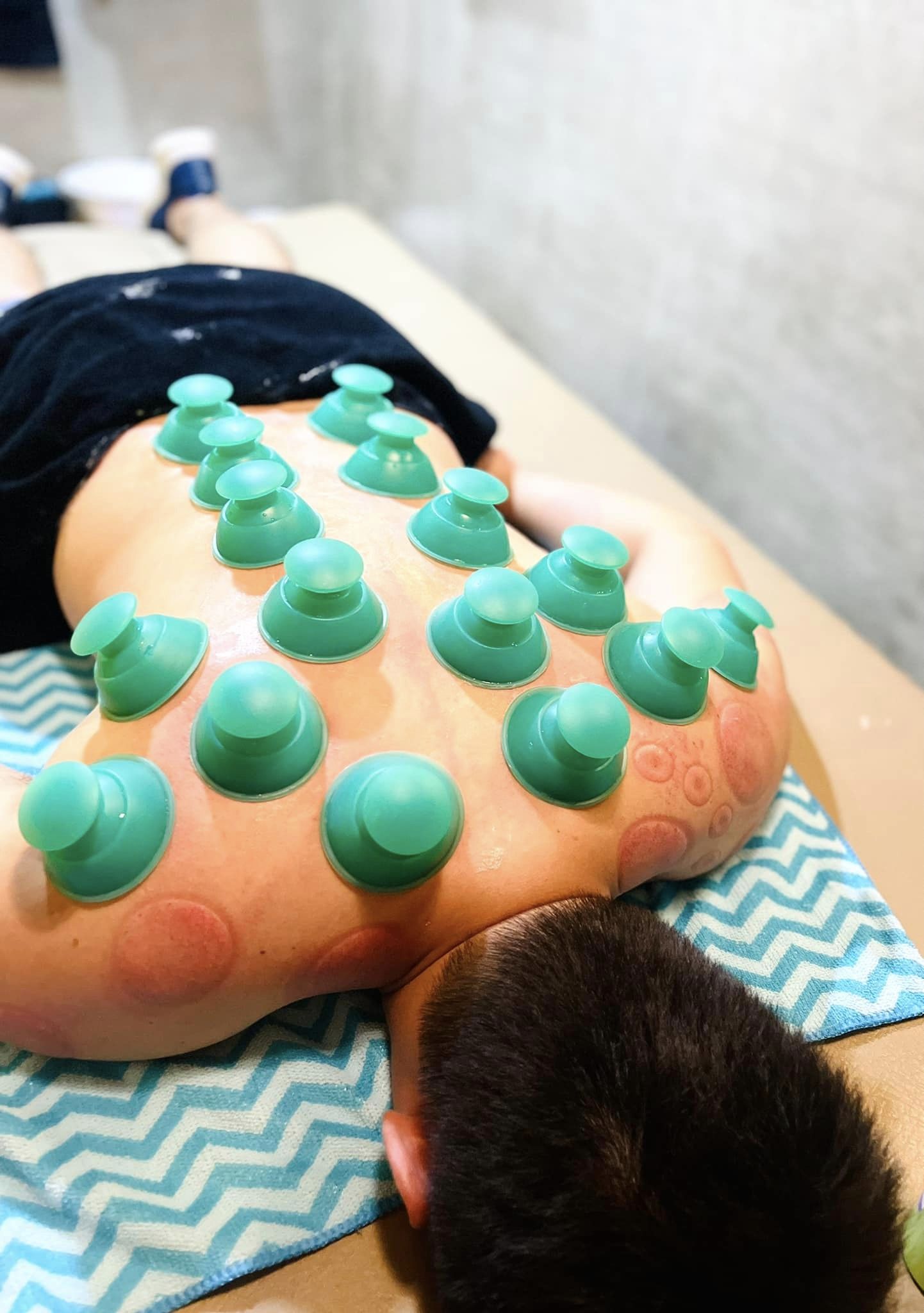 Functional IASTM and Functional Chinese Cupping Bundle (SAVE 40% OFF)