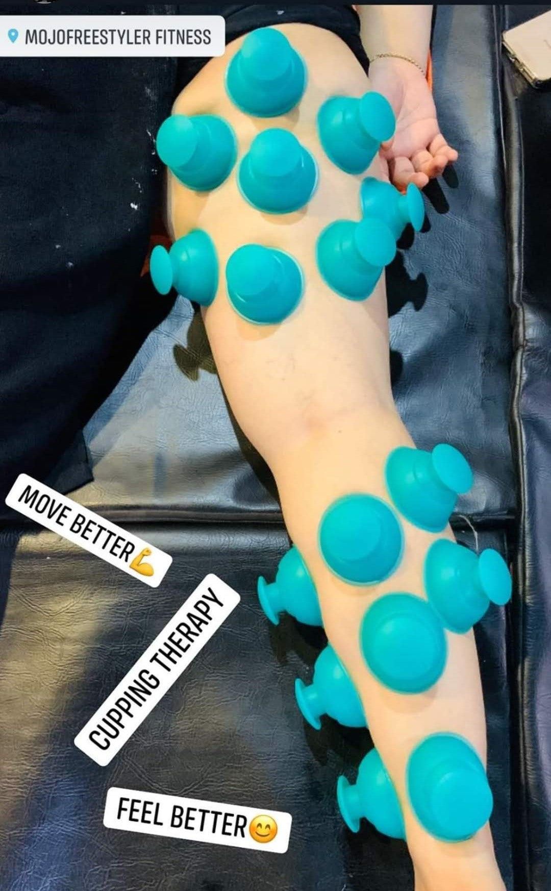MobilityPODS - Functional Chinese Cupping